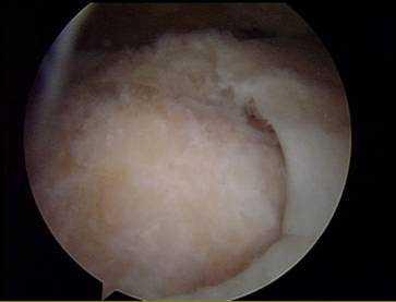 Schultergelenksspiegelung (Arthroskopie): degenerativer Sehnenriss